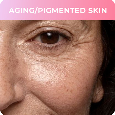Ageing Pigmentation Skin