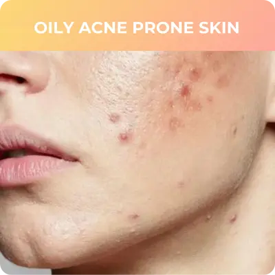 Acne Prone skin