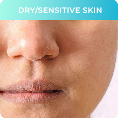Dry Sensitive Skin